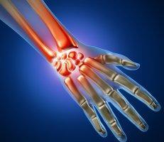 Carpal Tunnel